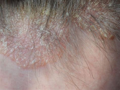 Scalp Psoriasis: What Dermatologists Wish You Knew | Best Health