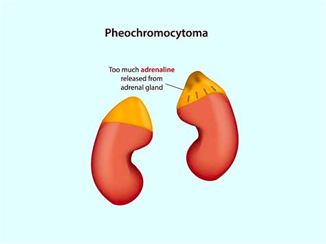 Adrenal-Sparing Surgery Better for Pheochromocytoma