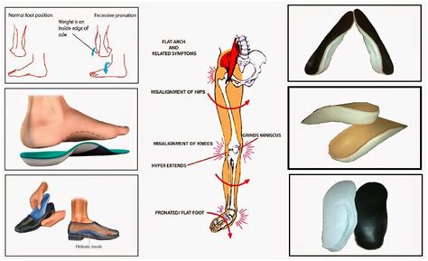 Flat Foot,(pes Planus) Corrector | ubicaciondepersonas.cdmx.gob.mx