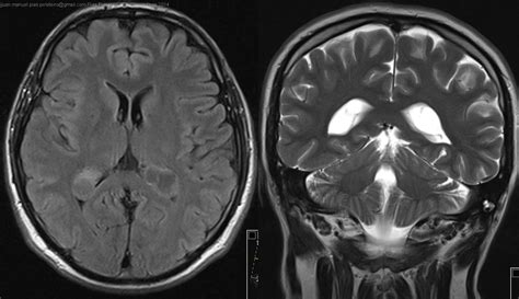 Xantogranulomas de plexos coroideos como hallazgo incidental | Neurorecordings