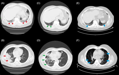 (A, B) CT scan in February 2021: Focal consolidative airspace disease... | Download Scientific ...