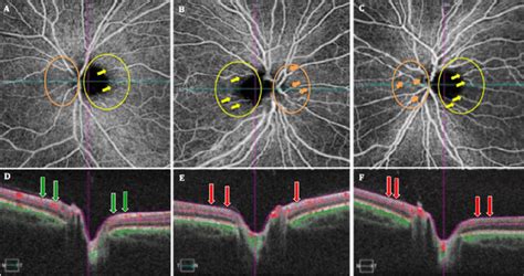 Shows optical coherence tomography angiography (OCTA) images (A-C) of... | Download Scientific ...