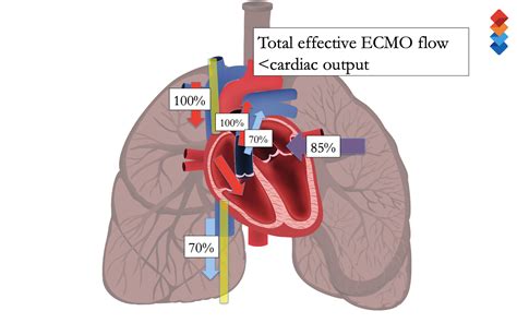 ECMO Institute | Online ECMO Training Course