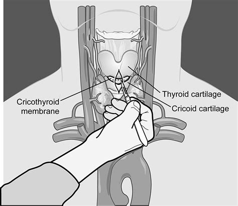 Needle Cricothyrotomy - Emergency Medicine Clinics