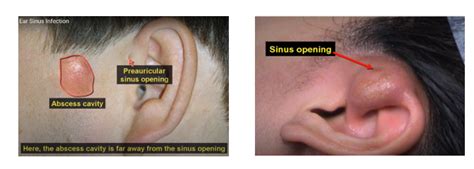 preauricular cyst excision