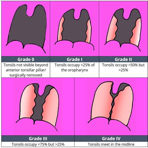 Tonsillar Hypertrophy Score