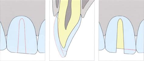 All-Ceramic Systems—Clinical Aspects of the All-Ceramic Crown | Pocket Dentistry