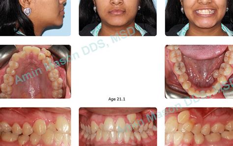 Self-Ligating Braces Columbus | Polaris Orthodontic Center