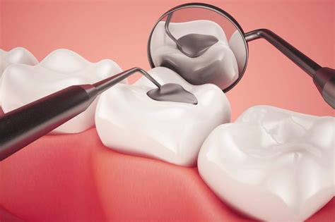 Tooth Filling » Haihyvanshi Dental Clinic