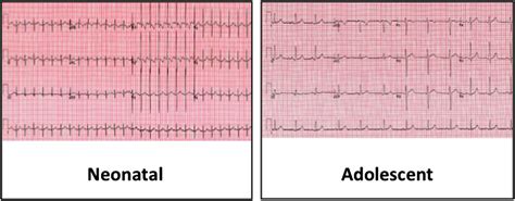 How to use…the paediatric ECG | ADC Education & Practice Edition