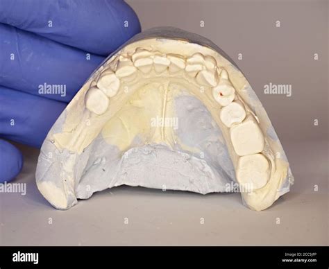 Molding dentist material. Cast model showing tooth decay in dental clinic for diagnosis and ...