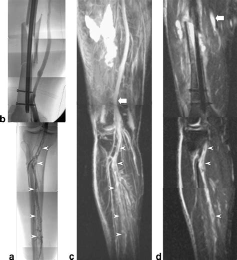 Figure 6 from Deep vein thrombosis using noncontrast-enhanced MR ...