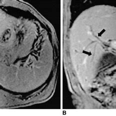 Clonorchiasis in a 58-year-old man. A. Transverse T2-weighted single... | Download Scientific ...