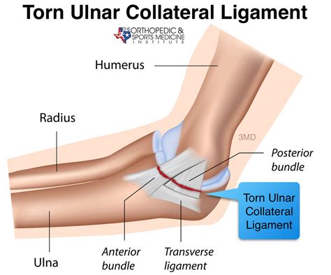 OSMI-Torn-ucl-Tommy-John-elbow-surgery