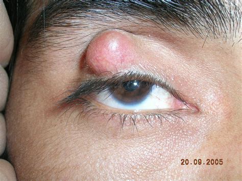 Chalazion – Symptoms, Pictures, Surgery, Treatment and Removal