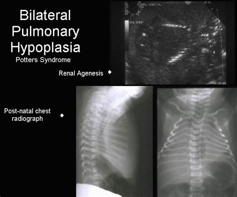 Bilateral Renal Agenesis