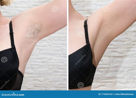 Woman Underarms, Armpit before and after Depilation, Laser Waxing and Sugaring Stock Photo ...