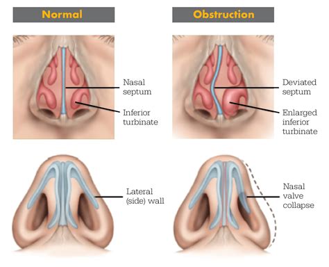 What Causes Swollen Nasal Passages