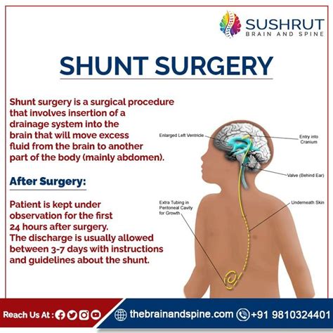 SHUNT SURGERY Shunt surgery is a surgical procedure that involves insertion of a drainage system ...