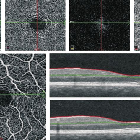 Fluorescein angiography images A: Fluorescein angiography of the left... | Download Scientific ...