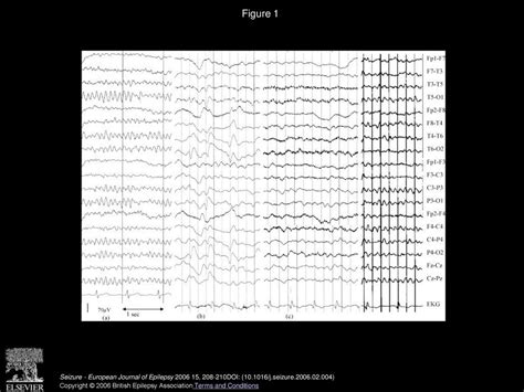 Pregabalin-associated acute psychosis and epileptiform EEG-changes - ppt download