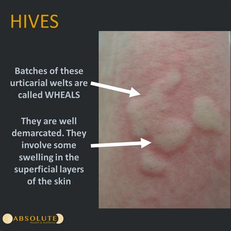 Urticaria Hives Overview And More - vrogue.co