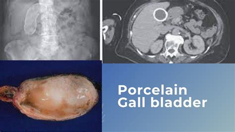 Porcelain Gallbladder - YouTube