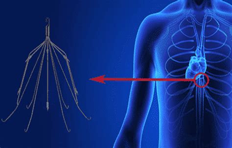 Use of inferior vena cava filters for treatment of VTE: SIR Guideline