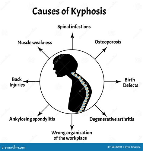 Causes of Kyphosis. Spinal Curvature, Kyphosis, Lordosis, Scoliosis ...