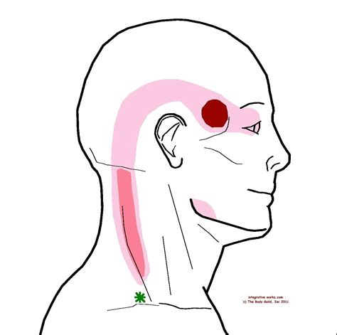 Understanding Trigger Points – Headache At Your Temple | Fibromyalgia, Referred pain and Chronic ...