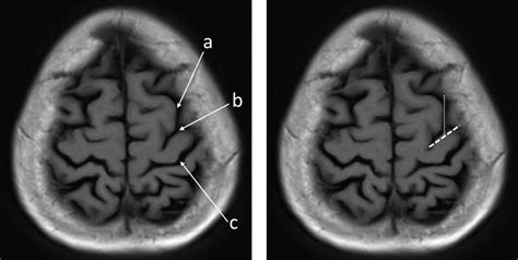 Central sulcus – Radiology Cases