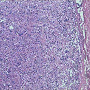 Histology of extratesticular Sertoli cell tumor with characteristic ...