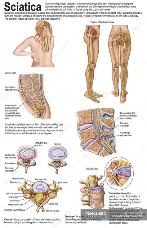 Sciatic nerves - Stock Photos, Royalty Free Images | Focused