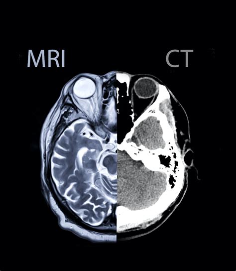 CT・MRI ー各々の役割ー | 脳疾患を知る | 桑名眼科脳神経クリニック