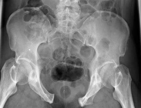 Pelvic Fracture, X-ray Photograph by Du Cane Medical Imaging Ltd