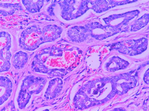 Adenoid cystic carcinoma – Histopathology.guru