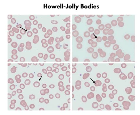 Red Cell Inclusions • The Blood Project