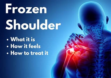 Everything you need to know about: Frozen Shoulder (Adhesive Capsulitis ...