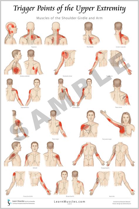 Trigger Point - Upper Extremity 24" x 36" Premium Poster 2 Pack - Learn ...