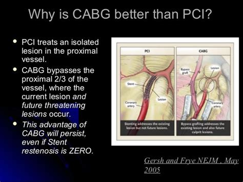 Pci vs cabg