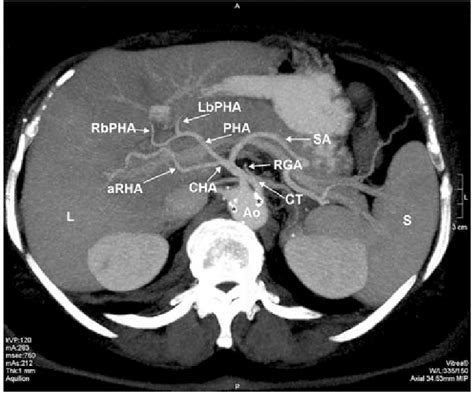 Dual-phase helical CT, transverse scan on the L1 level: Ao abdominal... | Download Scientific ...