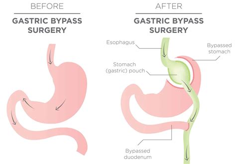 Consent: Gastric Bypass - TeachMeSurgery