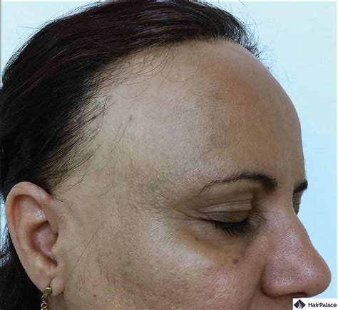 Frontal Fibrosing Alopecia | Causes, Symptoms and Treatments