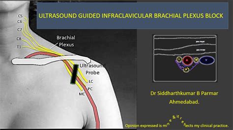 Ultrasound guided infraclavicular brachial plexus block - YouTube