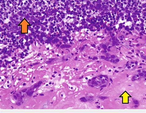 Pathological histology of squamous cell carcinoma, lymph node biopsy... | Download Scientific ...