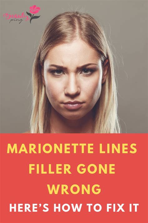 Marionette Lines Filler Gone Wrong? Here’s How to Fix It | Marionette ...