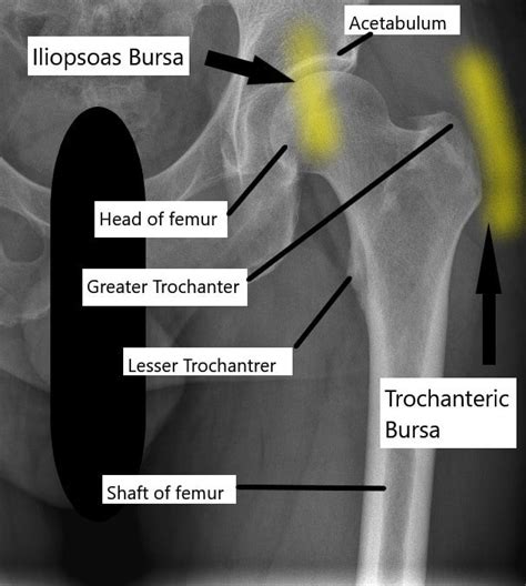 Severe Symptoms Of Hip Bursitis