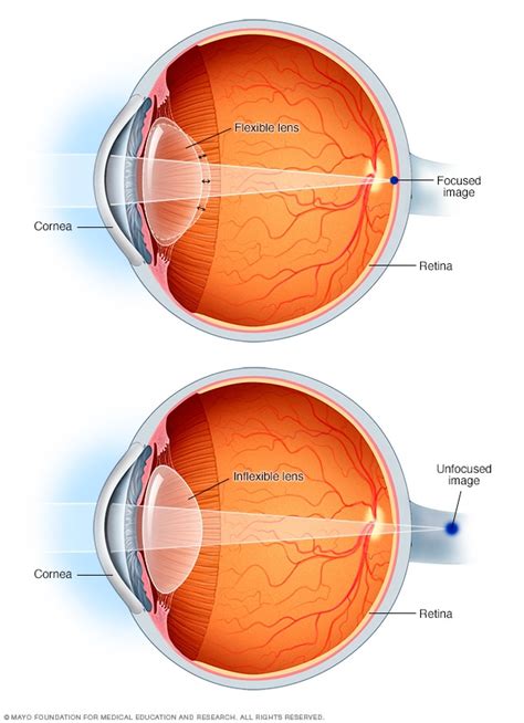 Presbyopia - Symptoms and causes - Mayo Clinic