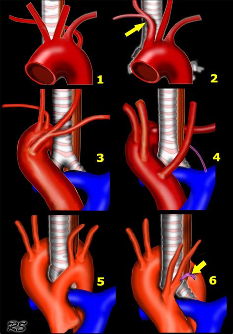 The Radiology Assistant : Vascular Anomalies of Aorta, Pulmonary and Systemic vessels