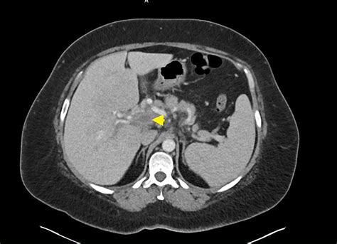 Cureus | Portal Vein Thrombosis Secondary to COVID-19: A Rare Complication